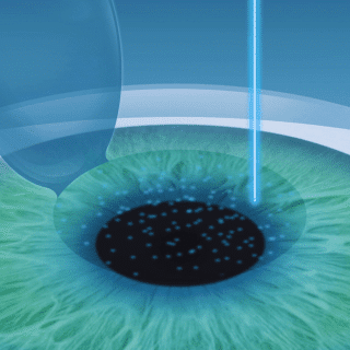 Femto_Lasik