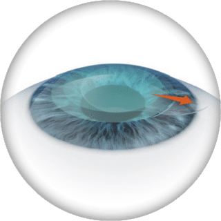 Hornhautverkrümmung 5 SmartSight