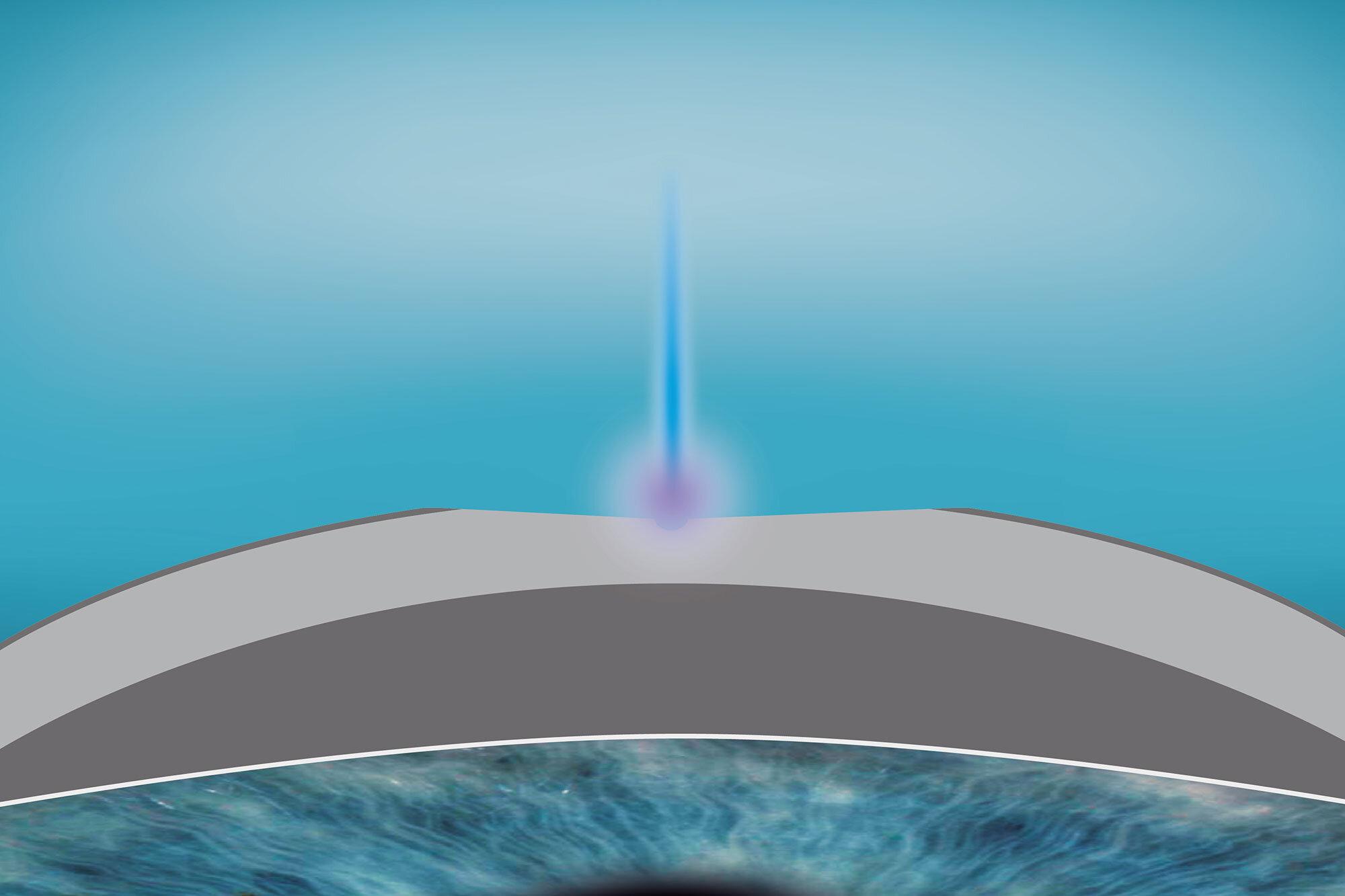 smartsurface-regular-cornea-02