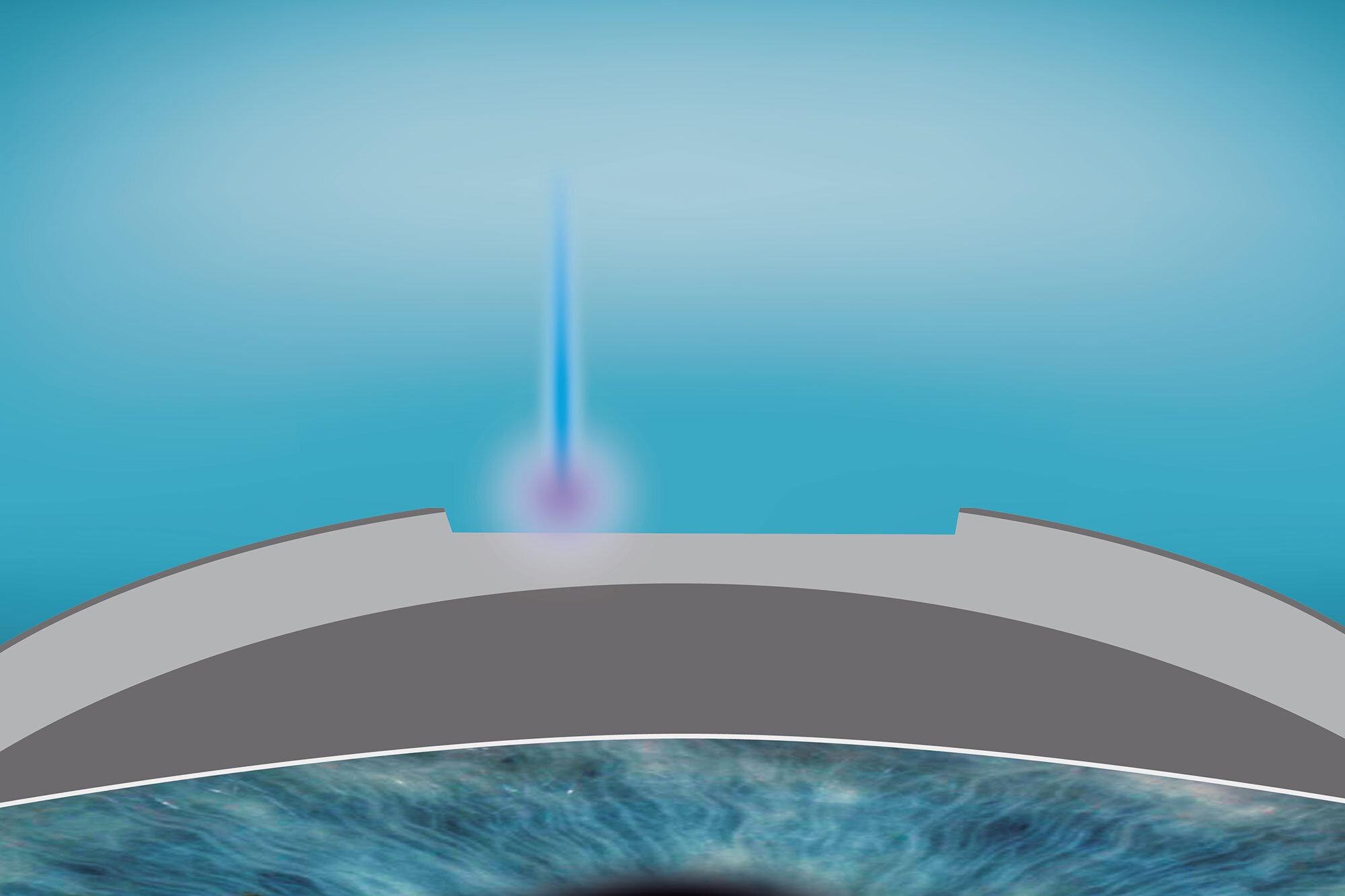 smartsurface-regular-cornea-03
