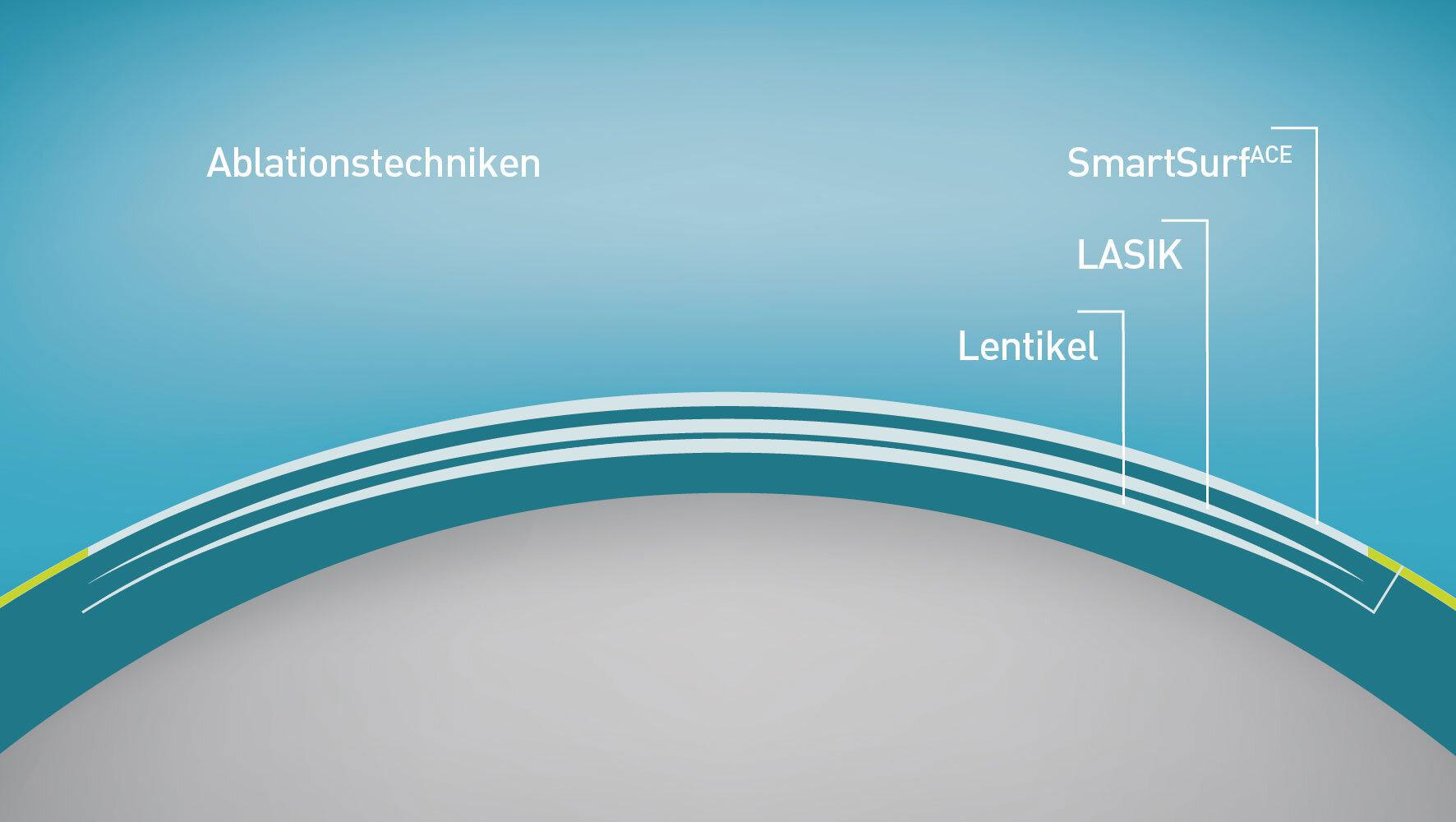 three procedures SmartSurf