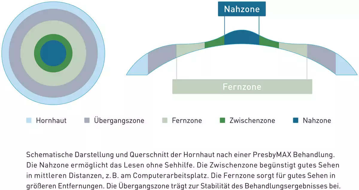 Nah und Fernzone PresbyMAX