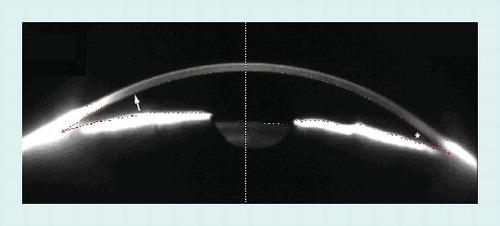 Scheimpflug imaging anterior segment 3D eye
