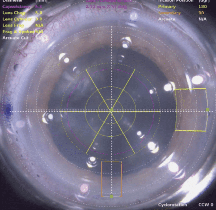 cataract density imaging lens fragmentation pattern ophthalmology