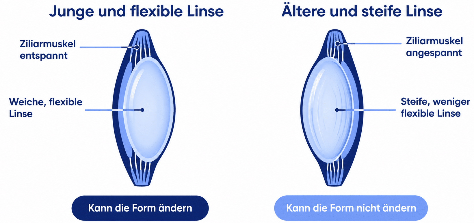 Junge und ältere Linse im Vergleich