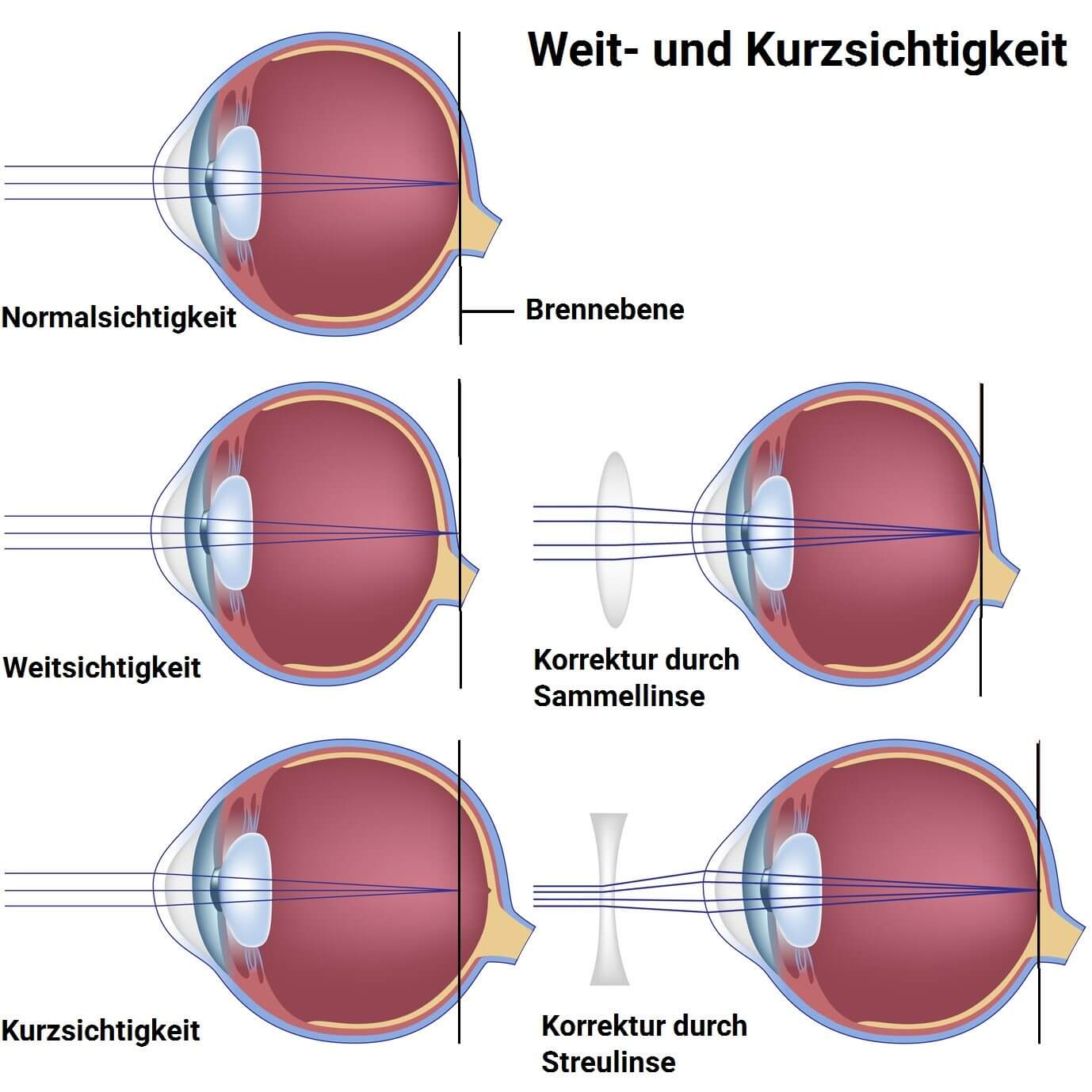 Weitsichtigkeit Symptome