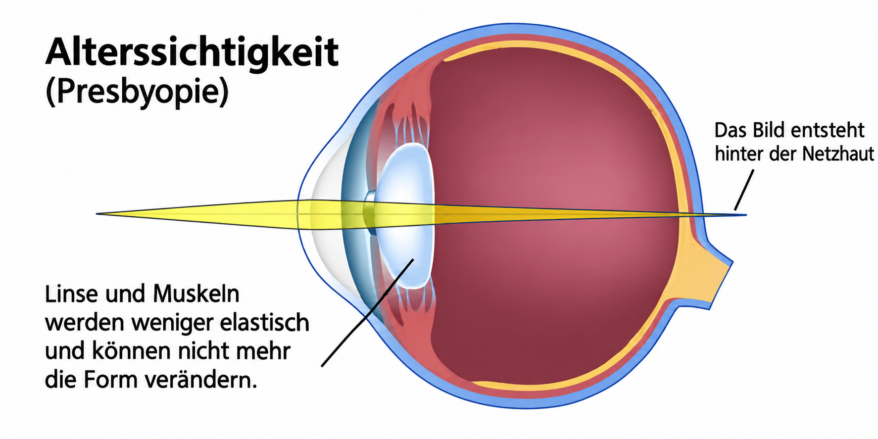 alterssichtigkeit-symptome-nahsicht
