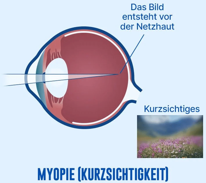 kurzsichtigkeit_myopie