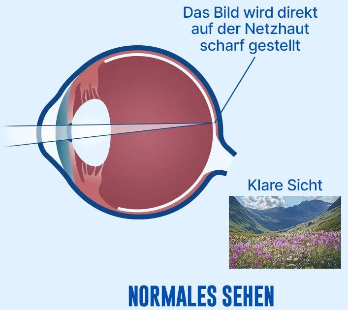 kurzsichtigkeit_normal