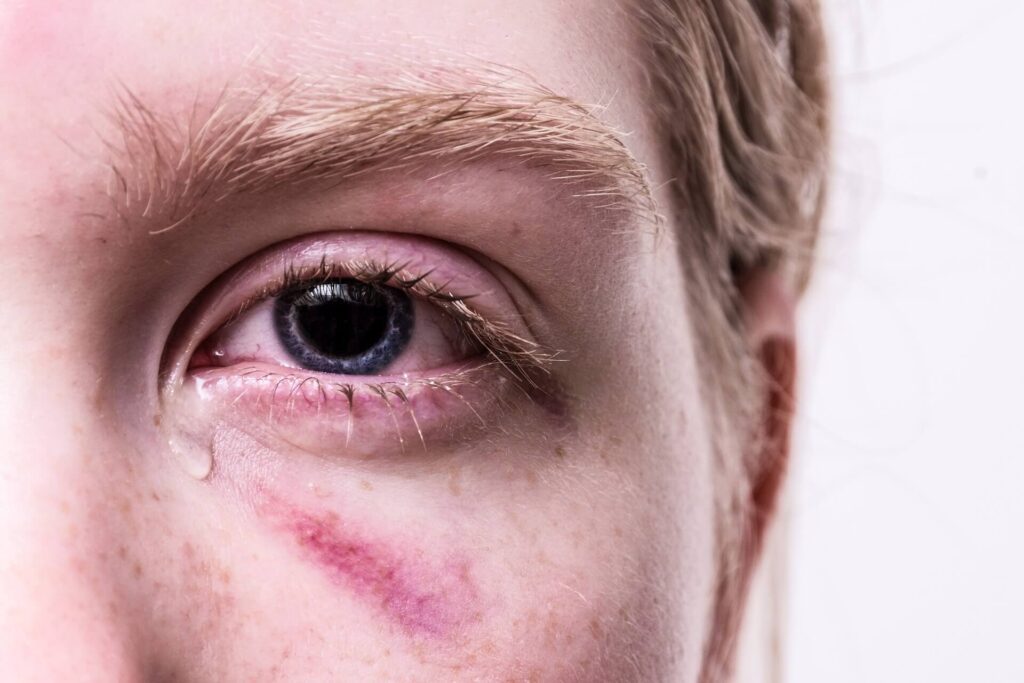 Rotes Auge, Bindehautentzündung & Augennotfall