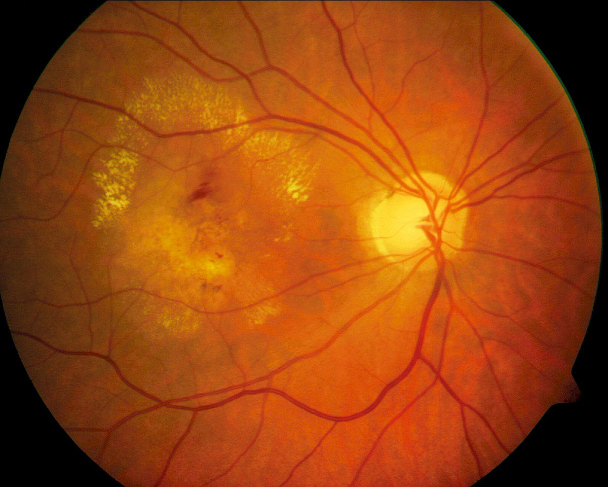 Intravitreale Medikamenteneingabe (IVOM) bei Makuladegeneration